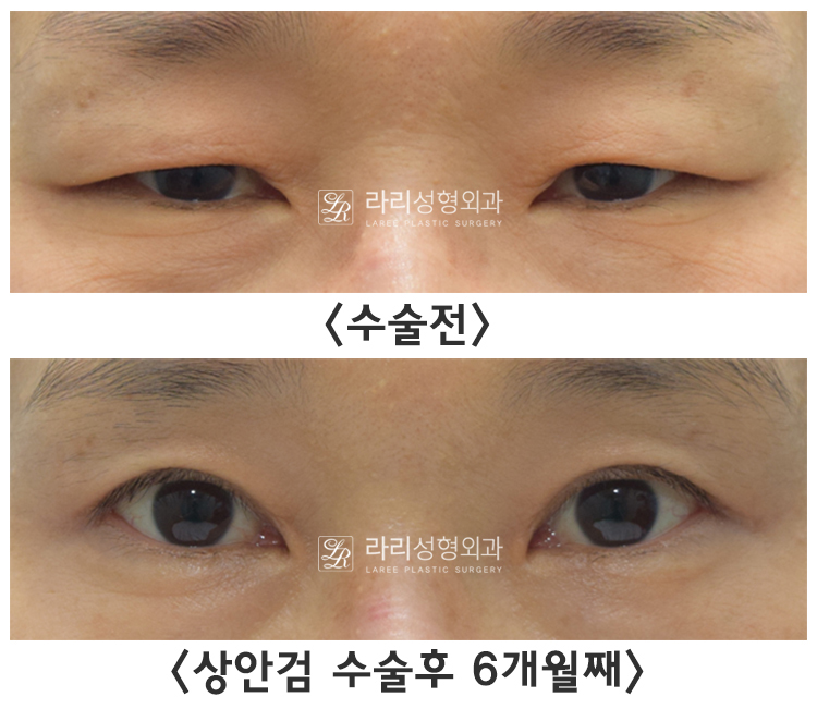 [라리성형외과] 눈꺼풀 처짐 개선하는 상안검수술, 무쌍상안검성형도 가능 관련 이미지 5