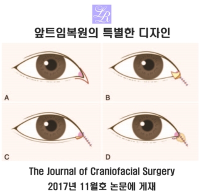 Understanding Medial Epicanthoplasty Revision Surgery - Methods Such as the Turnover Reverse Rotation Flap Technique image 1