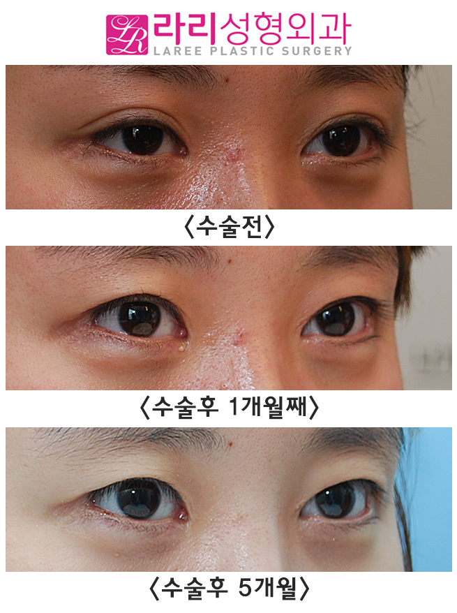 [라리성형외과] 쌍꺼풀없애는수술로 눈매교정과 짝눈교정을 한번에 (겉쌍에서 속쌍, 무쌍으로의 변화) 관련 이미지 2
