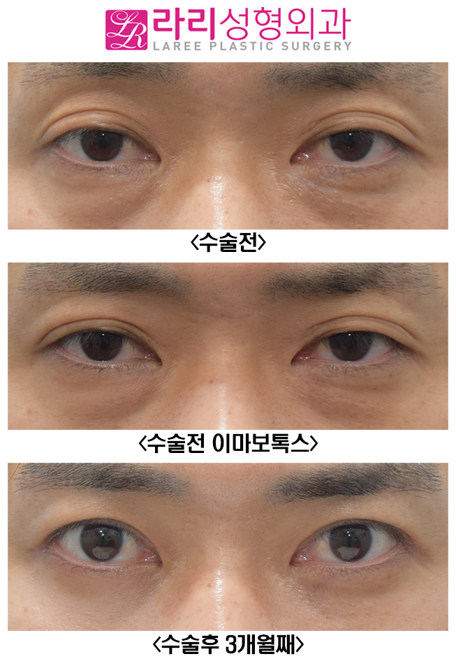 [라리성형외과] 여러겹 쌍꺼풀 제거 관련 이미지 1