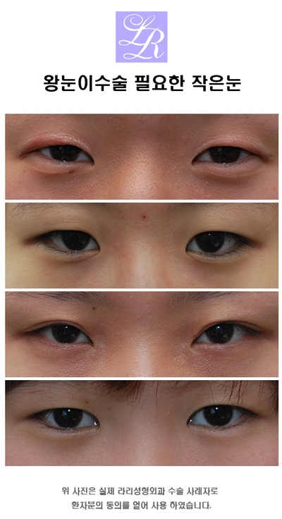 Small Eyes Surgery That Makeup Can’t Fix - Big-Eye Surgery image 3