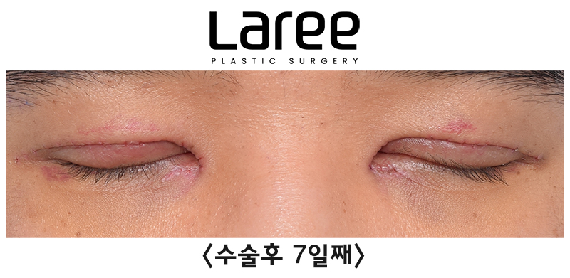 [Lari Plastic Surgery] Eyelid Correction Surgery and Upper Canthoplasty: Experiencing the Maximum Effect of Non-Double-Eyelid Eyelid Correction Without Medial Drooping image 7