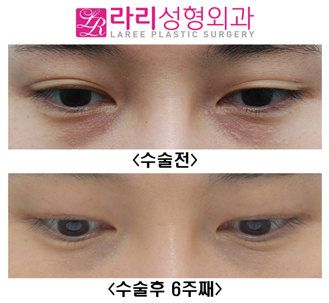 [Lari Plastic Surgery] Short-term progress after surgery to remove a natural double eyelid and make it monolid image 3