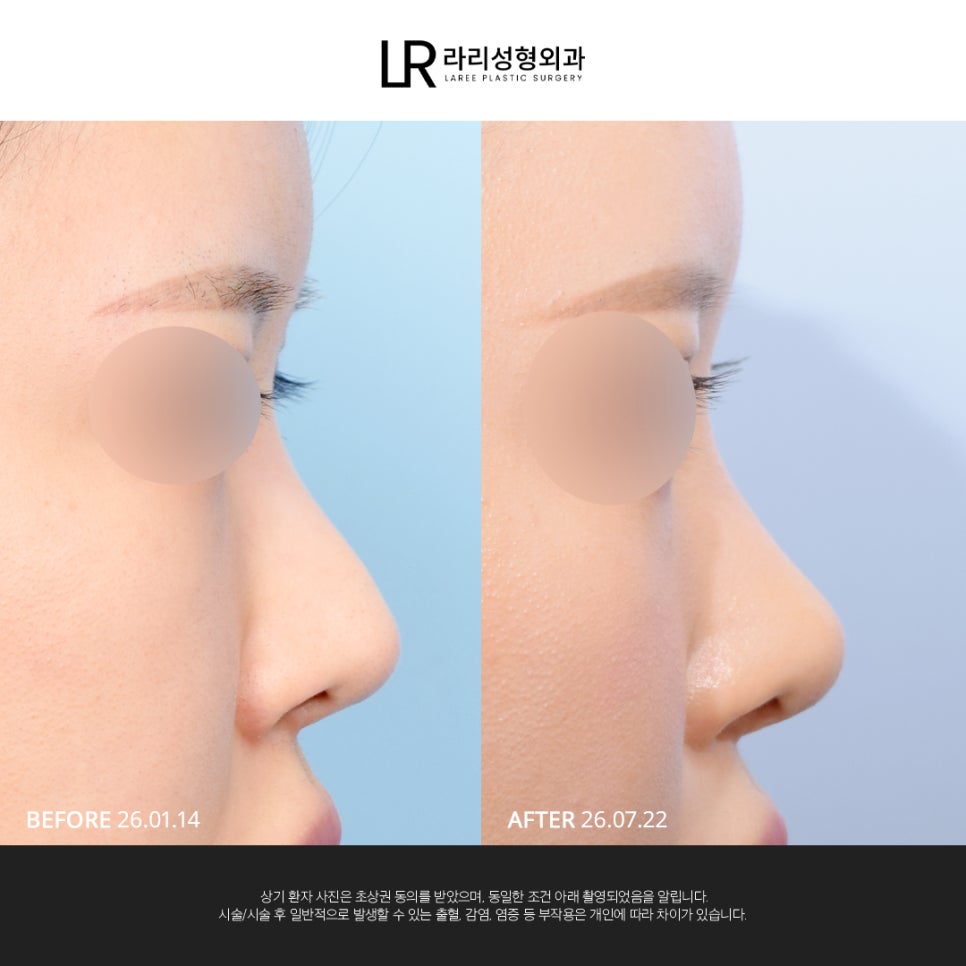 [LARI Plastic Surgery] Structural Line Rhinoplasty Revision Connecting the Nasal Bridge, Dorsum, and Tip image 2