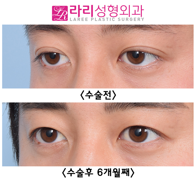 [Rari Plastic Surgery] Double-Eyelid Removal Surgery That Corrects Three-White Eye Without Lower Eyelid Surgery image 3