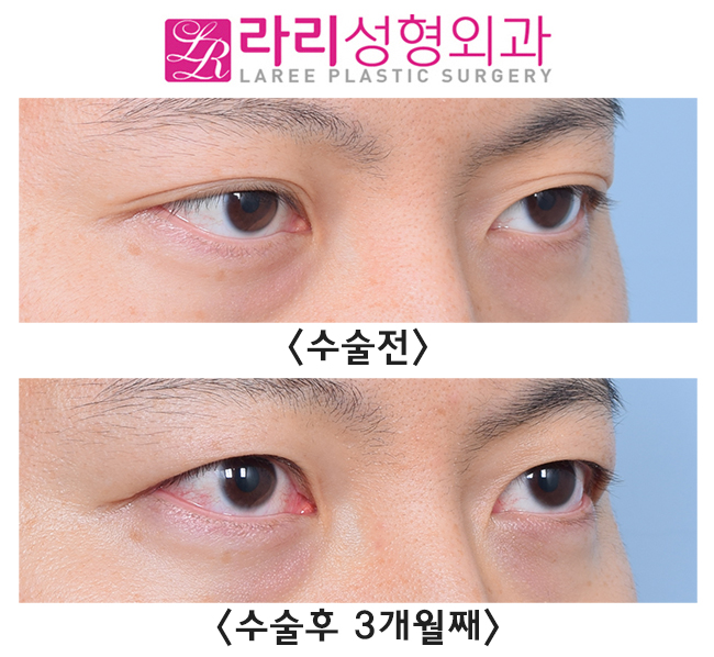 [Rari Plastic Surgery] Recovery Process for Line Irregularity During the Course of Double Eyelid Removal Surgery image 2