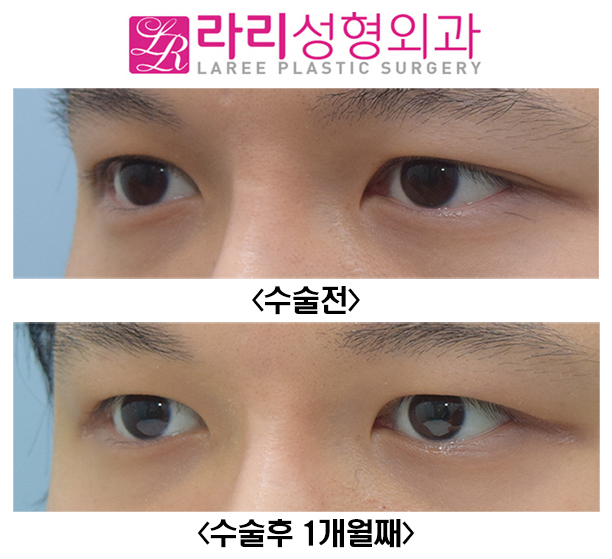 [Lari Plastic Surgery] Before and After of Double Eyelid Reversal Surgery, Which Can Also Remove a Hidden Double Eyelid image 5