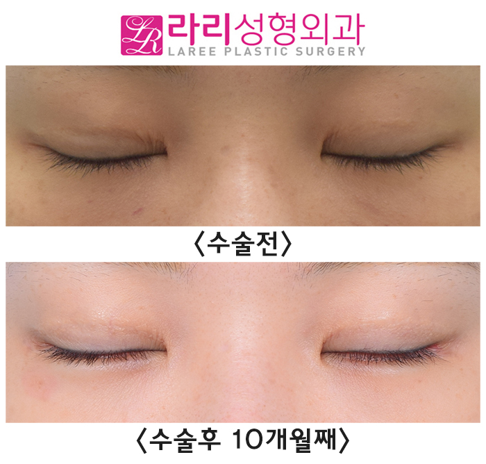 [Lari Plastic Surgery] Before-and-After Photos of Double Eyelid Revision Surgery and Lateral Canthoplasty Revision Surgery That Leave Nothing Out image 2