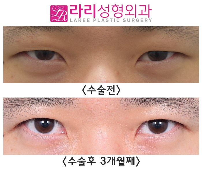 [Lari Plastic Surgery] Before and After Double-Incision Non-Incisional Eyelid Correction Surgery for Men That Makes the Eyes Exactly Twice as Big image 2
