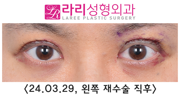 [라리성형외과] 쌍꺼풀없애는수술 후 필요에 의한 재교정과 회복 과정 기간별 사진 관련 이미지 3