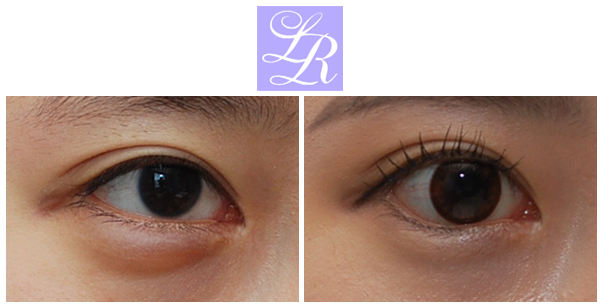 If You Want an S-Line Under Your Eyes, Try Lower Eye Widening image 2