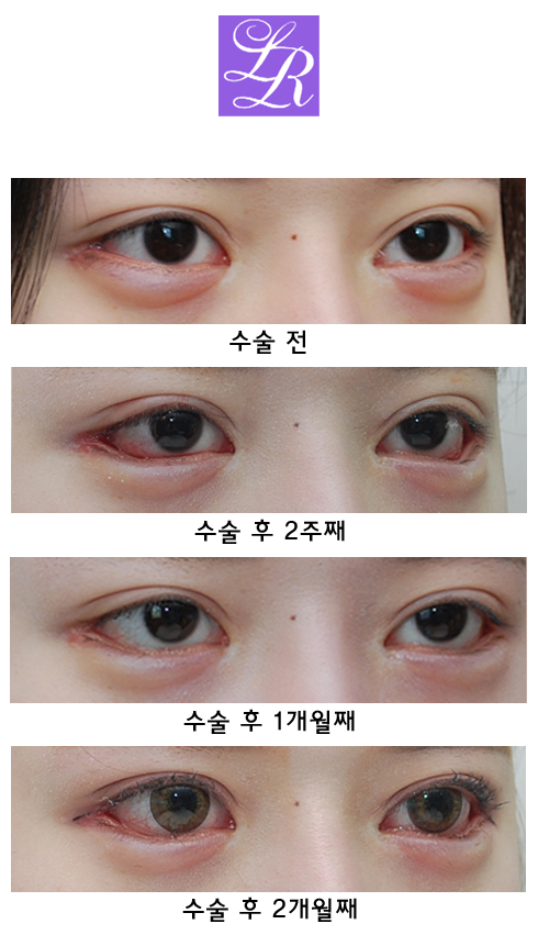 Long-Term Follow-Up Review Confirming the Effect of Lower Canthoplasty image 6