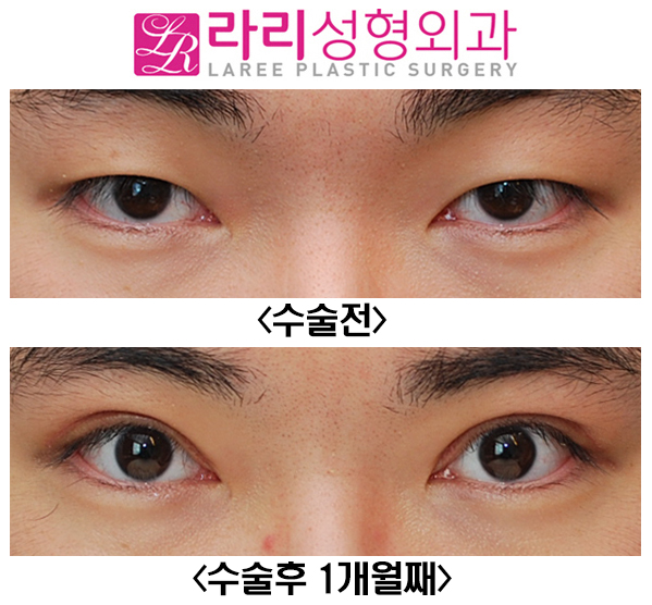 [Lari Plastic Surgery] Full Non-Incision Eye Correction, Effects and Before-and-After Photos (Different from Double Eyelid Surgery) image 2