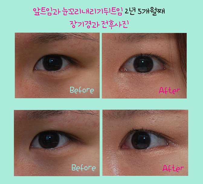 눈꼬리내리기뒤트임/뒷트임 장기경과 후기 효과가 확실하네~☆ 관련 이미지 9