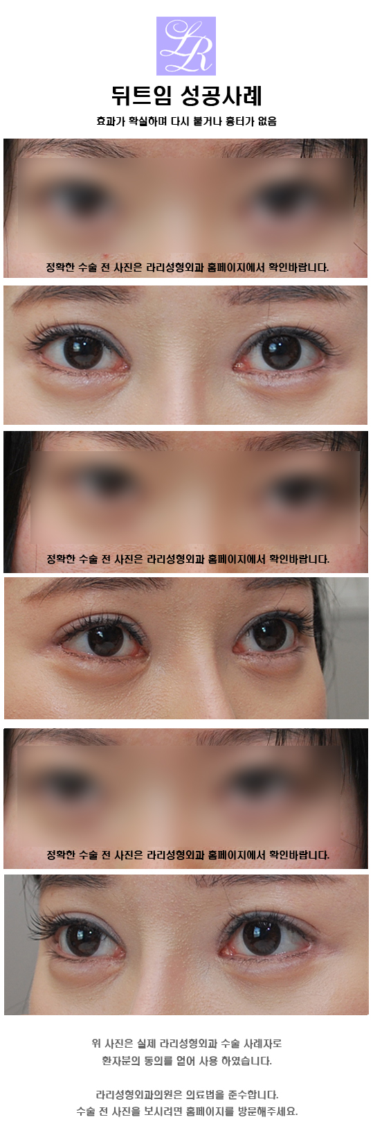 외안각고정술 뜻 - 뒤트임의 한 방법이죠 관련 이미지 2