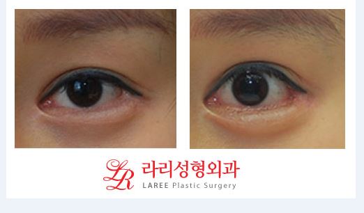 ※What Is the Wise Choice for Double Eyelid Revision Surgery?※ image 3