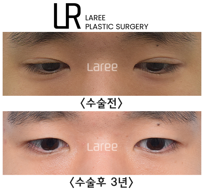 [라리성형외과] 쌍꺼풀없애는 무쌍 수술, 쌍꺼풀라인 낮추기가 아닙니다. (완전무쌍과 무쌍속쌍 그 차이) 관련 이미지 4