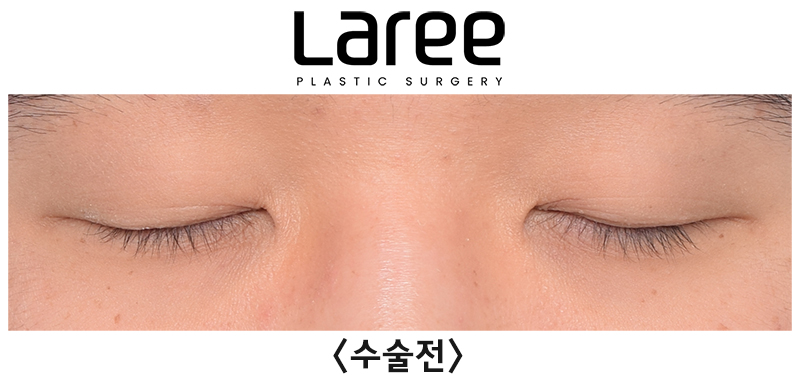 [Lari Plastic Surgery] Eyelid Correction Surgery and Upper Canthoplasty: Experiencing the Maximum Effect of Non-Double-Eyelid Eyelid Correction Without Medial Drooping image 2