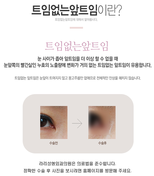 몽고주름없애는 앞트임후기 관련 이미지 4