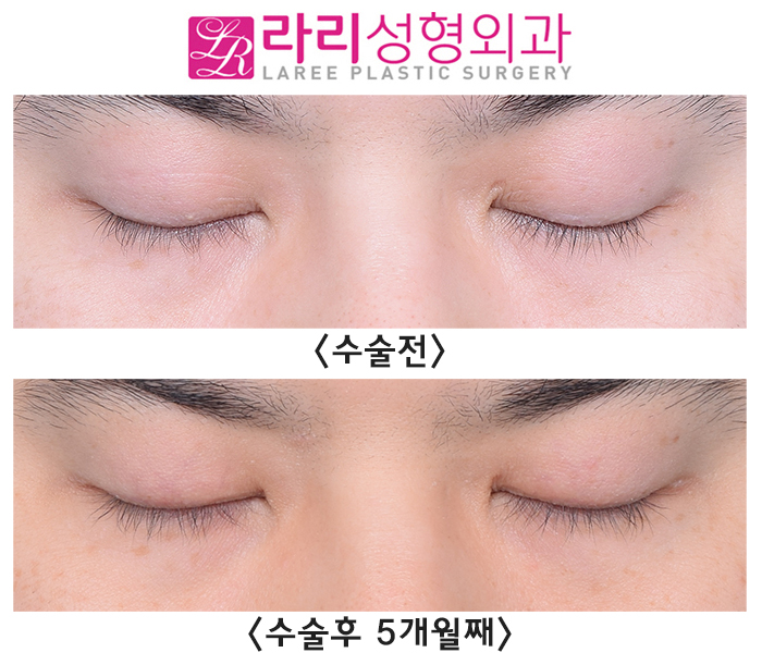 [Lari Plastic Surgery] Completely monolid, removing a natural double eyelid: the eyes close well too. image 5