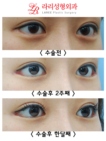 8-Year Long-Term Follow-Up vs. 2-Week Short-Term Follow-Up in the Same Patient (Lateral Canthoplasty & Revision Lateral Canthoplasty) image 7