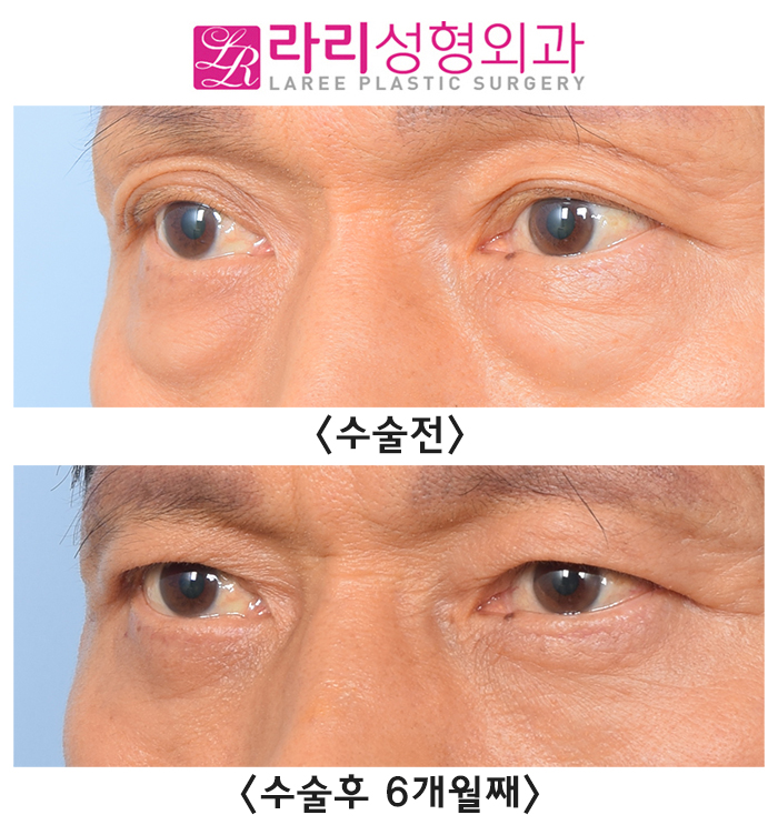 [Lari Plastic Surgery] Correction Surgery Before and After for Old Double Eyelid Surgery Side Effects, Sagging Skin, and Multiple Folded Double Eyelids image 2