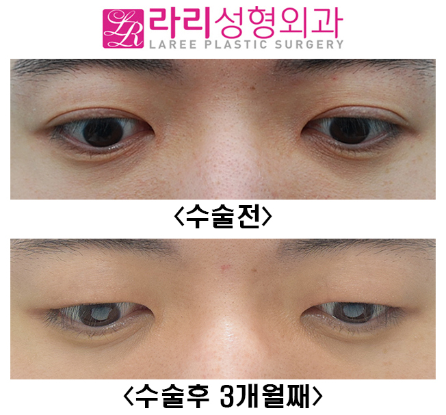 [Lari Plastic Surgery] Before-and-After Photos of Male Double Eyelid Removal Surgery at 3 Months image 3