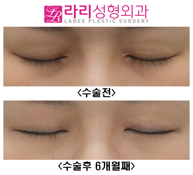 [라리성형외과]  앞트임복원수술 하지 않고 앞트임흉터 제거하는 방법 관련 이미지 6