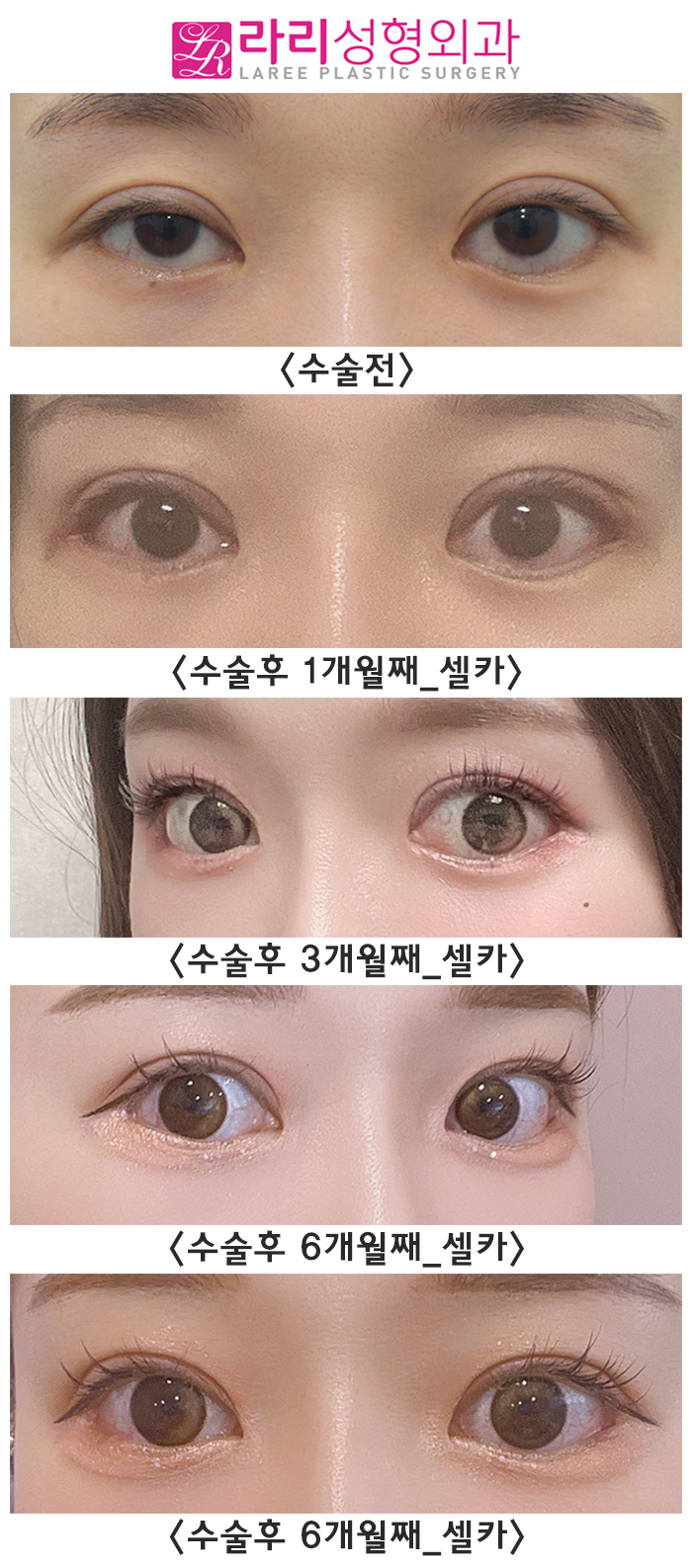 [라리성형외과] 쌍꺼풀재수술, 밑트임복원, 뒤트임재수술 후 다시 태어난 눈 리얼 셀카 후기 관련 이미지 5