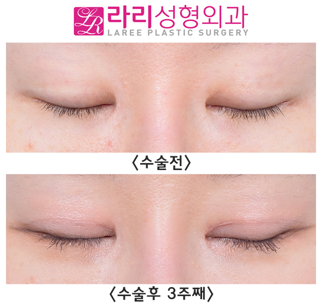 [라리성형외과] 소세지쌍꺼풀 라인 확 낮추는 게 훨씬 예뻐요. 관련 이미지 4
