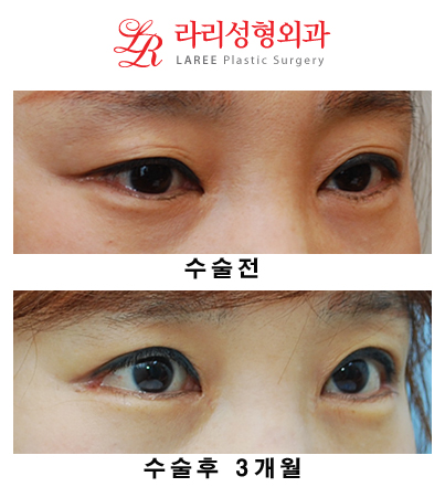 Revision Eyelid Surgery, Cases That Need Ptosis Correction, Correcting Asymmetry in Uneven Eyes image 3