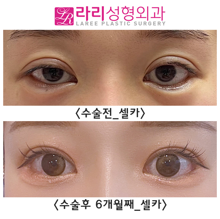 [라리성형외과] 쌍꺼풀재수술, 밑트임복원, 뒤트임재수술 후 다시 태어난 눈 리얼 셀카 후기 관련 이미지 4
