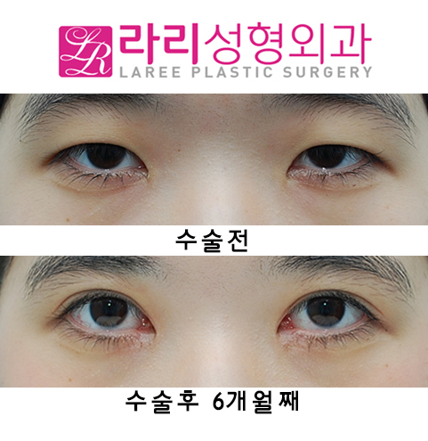[라리성형외과] 절개쌍수 눈매교정 그리고 앞트임 관련 이미지 9