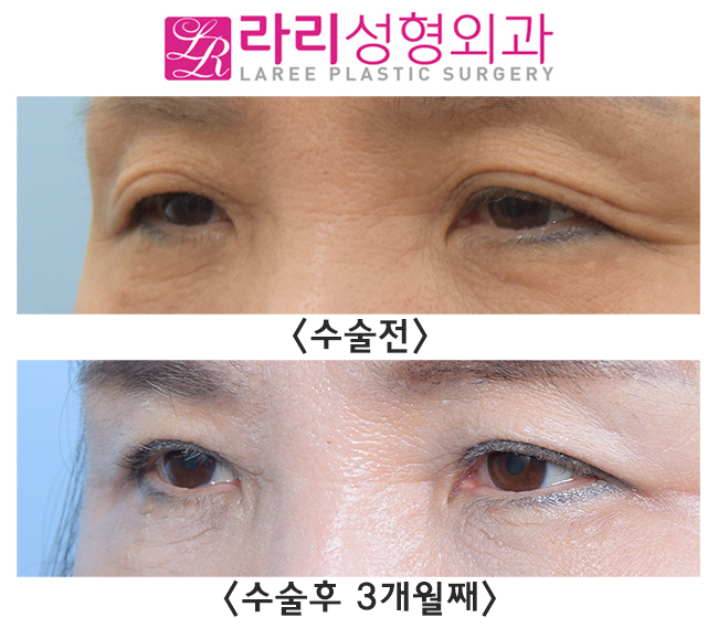 [Lari Plastic Surgery] The secret to looking 10 years younger in middle age is upper eyelid surgery! image 2