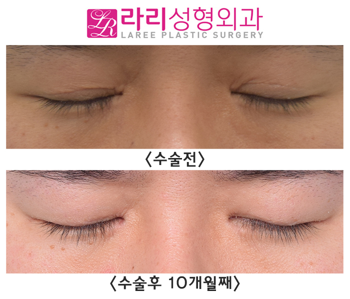[라리성형외과] 눈이 조금 작아져도 괜찮다면 완전 무쌍으로 쌍꺼풀없애기 수술을 받아요. 쌍꺼풀없애기, 앞트임재수술, 뒤트임 수술 후 10개월째 관련 이미지 2