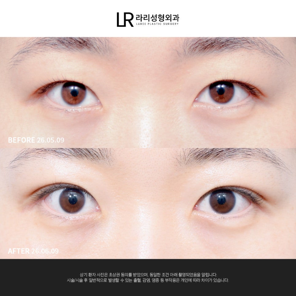 [라리성형외과] 눈 첫성형은 빠르고 간단한 매몰쌍수로 관련 이미지 3