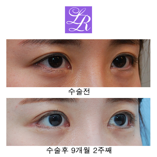 Changing Eyelid Crease Shape with Double Eyelid Reversal Surgery image 3