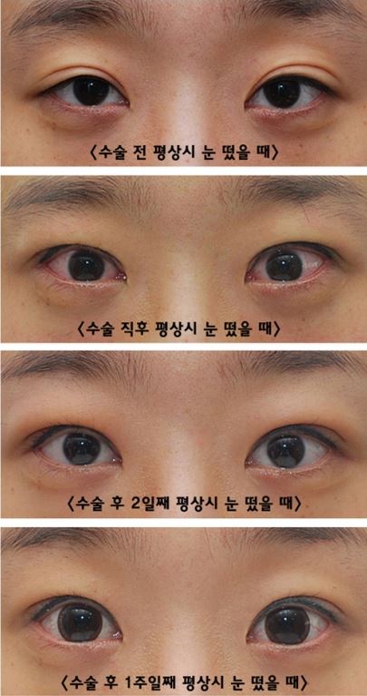 15-Minute Eye Correction Progress Before-and-After Photos image 1