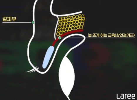 [라리성형외과] 쌍꺼풀수술 후 쌍꺼풀이 풀리는 이유 관련 이미지 1