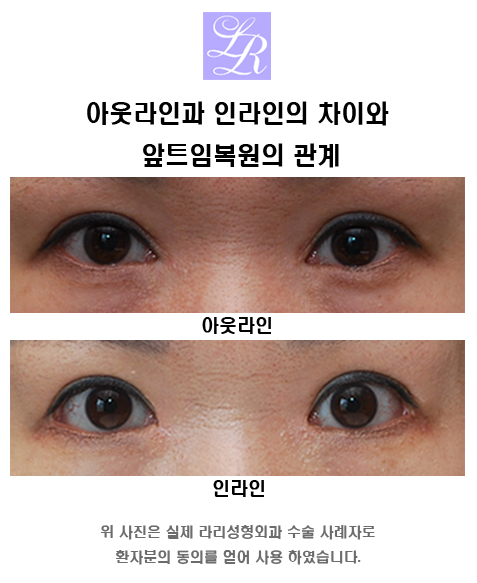 Eye In-Inner, Outer, and Double-Eyelid Line Selection image 6