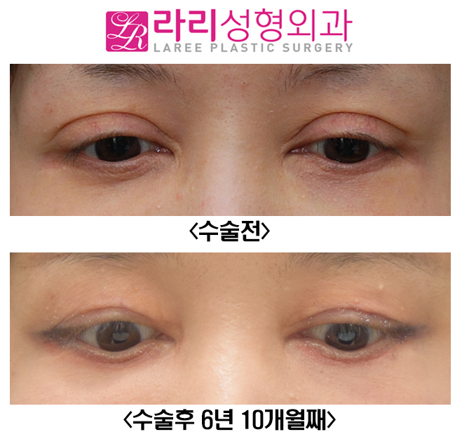 [라리성형외과] 쌍꺼풀재수술 6년 이상 장기경과 관련 이미지 3