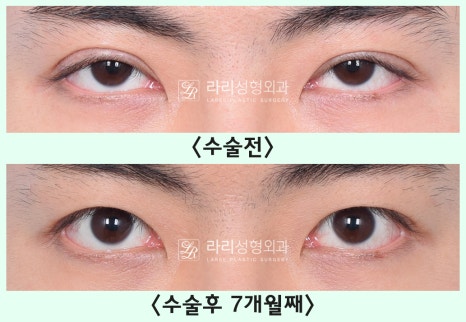 [Lari Plastic Surgery] Removing a Visible Double Eyelid (Double Eyelid Reversal Surgery), From Natural Double Eyelids to Surgical Double Eyelids: A to Z image 11