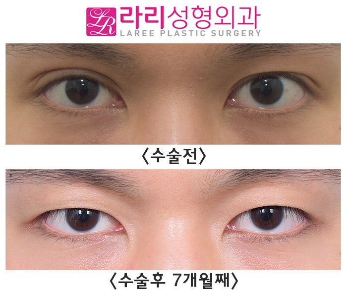 [라리성형외과] 자연쌍꺼풀 ? 쌍수쌍꺼풀 ? 쌍꺼풀없애는수술로 다른 양쪽을 같게 만들어요. 관련 이미지 1