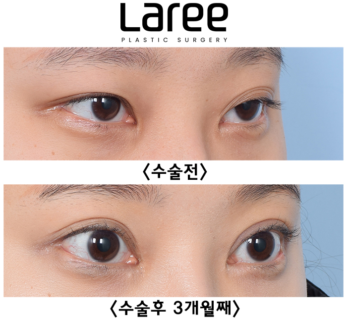 [Laree Plastic Surgery] One-Sided Release After Buried Double Eyelid Surgery, Multiple-Fold Double Eyelid Revision Surgery and Changes After Eyelid Correction image 4