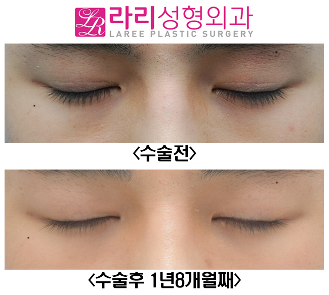 [라리성형외과] 쌍꺼풀없애기와 앞트임수술 전후사진 관련 이미지 2
