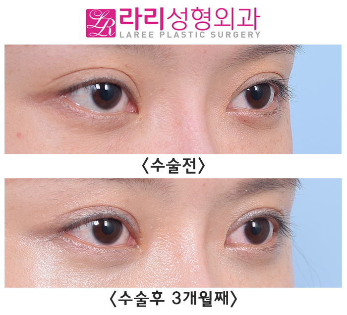 [Lari Plastic Surgery] Cases Where Revision Double-Eyelid Surgery Improves Scleral Show image 3