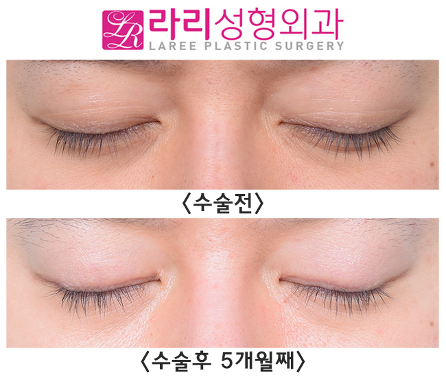 [라리성형외과] 완전 두꺼운 자연쌍꺼풀 무쌍 만들기 관련 이미지 3