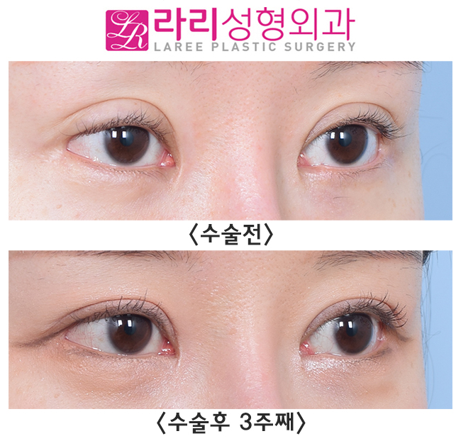 [라리성형외과] 소세지쌍꺼풀 라인 확 낮추는 게 훨씬 예뻐요. 관련 이미지 2