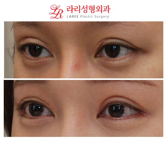 Revision Double Eyelid Surgery, Downward Outer Corner Epicanthoplasty Before and After Photos image 2