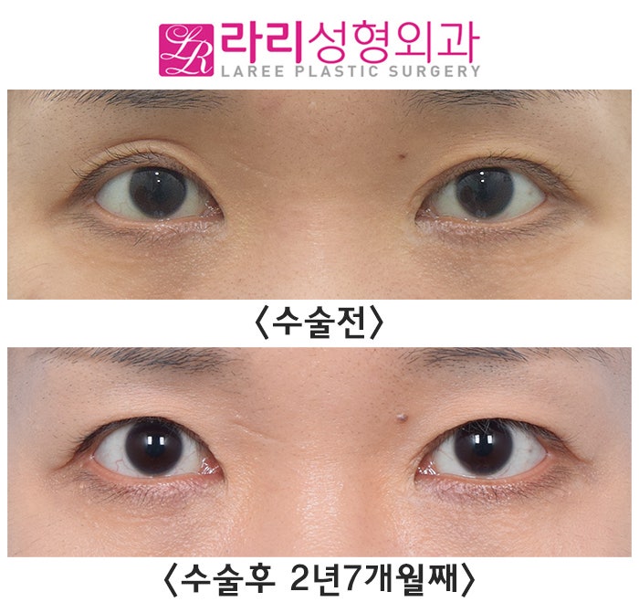[Lari Plastic Surgery] Before-and-After Photos of Double Eyelid Removal Surgery to Correct Eyelash Eversion image 2